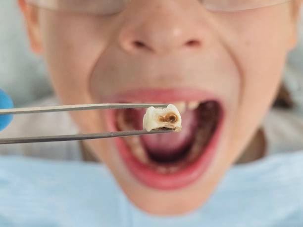 Best Emergency Broken Tooth Repair in Basile, LA